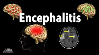 Encephalitis Animation [upl. by Viking138]