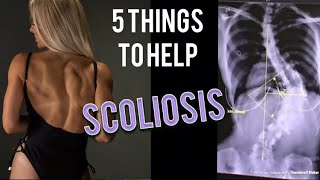 5 things to help SCOLIOSIS [upl. by Foscalina]