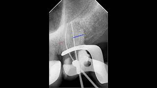 How to differentiate between the molar with two or 3 canals Part 2  Dr Malek Ashkar [upl. by Ititrefen]