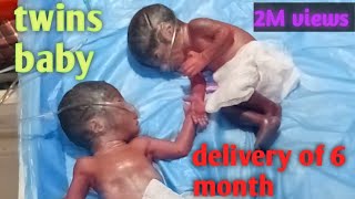 twins born of six month delivery very small twins twins babies [upl. by Salinas]