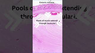 Histology of colitis cystica profunda [upl. by Anilek]