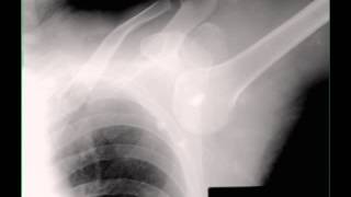 Left Shoudler Dislocation on X ray [upl. by Relyhs]