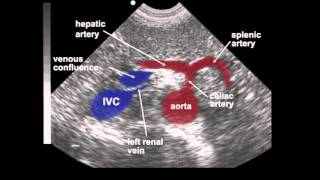 Abdominal Aortic Aneurysm AAA Ultrasound [upl. by Moia]