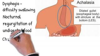 Esophageal achalasia  Symptoms diagnosis and treatment simply and shortly [upl. by Nanreh]