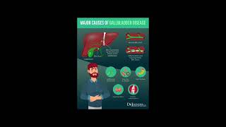 cholelithiasis nutritional factors [upl. by Emlin]