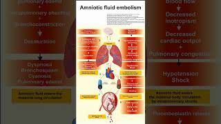 Amniotic fluid embolism [upl. by Suckram10]