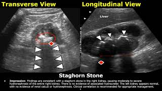 Kidney Ultrasound Reporting  Renal Diseases Scan Reports  How To Write USG Report  KUB USG [upl. by Christabella226]