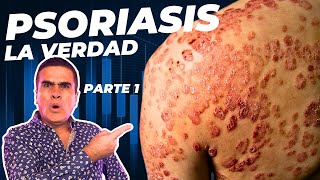 Qué es la Psoriasis 💔 Causas Complicaciones y Zonas ❤️‍🩹 Dra Natalia Merino  Dermatología [upl. by Corissa]