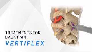 The Vertiflex Procedure  Treatments for Back Pain [upl. by Erbes]