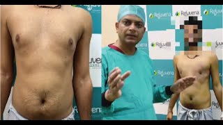 Gynecomastia Before and After Exercise  Gynecomastia Before and After  Gynecomastia Results [upl. by Ebanreb]