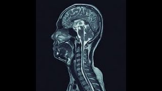 Cervicalgia Desidratação Abaulamento Discal Uncoartrose EVOLUÇÃO CLÍNICA Fisioterapia Robson Sitta [upl. by Kirat]