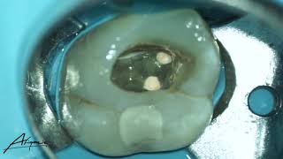 Obturation phase of the root canal treatment of maxillary second molar [upl. by Linda973]