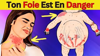 Maladie du foie gras  10 conseils vitaux pour protéger votre santé [upl. by Yentiw]