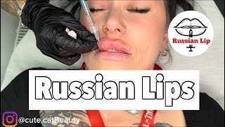 Russian Lips 2024  Lip Filler Full Video  Revolax Deep [upl. by Delcine]