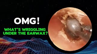 Horrifying  Insects combine with earwax to block the ear canal [upl. by Dickson550]