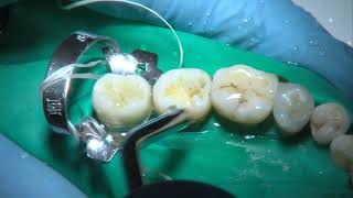 OPERATORIA DENTAL Y ENDODONCIA TÉCNICAS Y MATERIALES7 COMPOSITE CAVIDAD DE CLASE I [upl. by Dust]