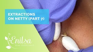 Extracting Blackheads on Netty  Seventh Treatment [upl. by Winikka999]