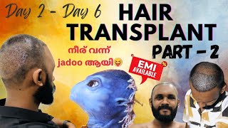 ✨Hair Transplant വിശേഷങ്ങൾ Part 2🤘🏻 [upl. by Ylremik]