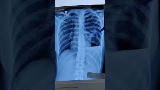 HOW TO DESCRIBE CHEST XRAY OF HYDROPNEUMOTHORAX PNEUMOTHORAX PLEURAL EFFUSIONchestxray ytshorts [upl. by Egan681]