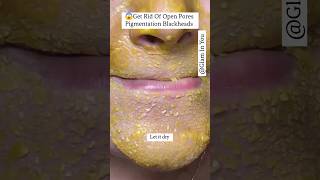 😱Get Rid Of Open Pores Pigmentation Blackheads shorts [upl. by Alejandro872]