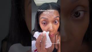 Chalazion surgery Part 4 chalazion surgeryday eyedoctor eyesurgery stye [upl. by Onibas931]