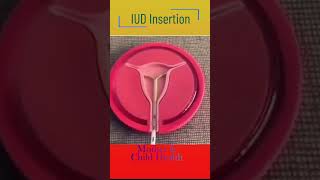 IUD insertion [upl. by Reo]