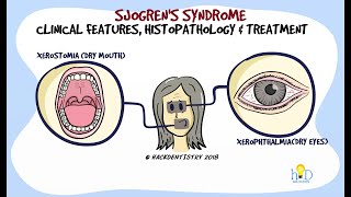 Sjogrens syndrome Part 2  Clinical features and Histopathology [upl. by Eninej]