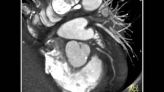 4D Imaging of the Aortic Valve Calcified aortic valve 1 of 3 [upl. by Enamrej]