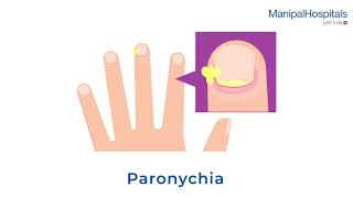 What is Paronychia and Its Treatment  Manipal Hospitals India [upl. by Sacram]