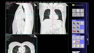 HRCT Scan Chest Techniq amp Filming [upl. by Assirek182]