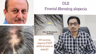 Scarring Alopecia  Lichen planopilaris  DLE  Frontal fibrosing alopecia alopecia lpp dle FFA [upl. by Dust]