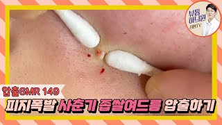 압출SMR 149 열많은 피부의 사춘기 여드름  10대 女 [upl. by Arnuad]