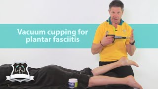 Vacuum cupping for plantar fasciitis [upl. by Kehoe516]