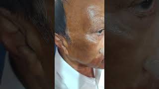 Pigmentation Melasma Remove Treatment by Dermapen PRP [upl. by Darrel]