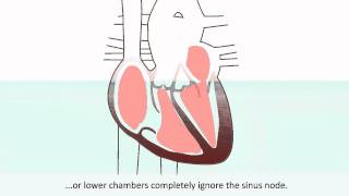 Arrhythmias  What is an arrhythmia and what treatments does it require [upl. by Rdnaskela]