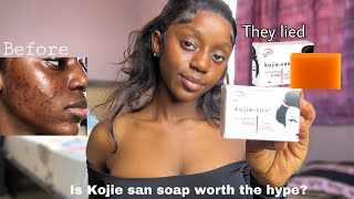 DID THEY LIE ABOUT KOJIE SAN SOAP HONEST REVIEW [upl. by Cinderella]