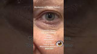 Myokymia healthtips eyecare eyediseases [upl. by Jeri]