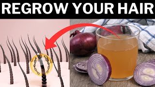 Natural Hair Regrowth Harnessing the Power Of Onion Juice  Onion Juice For Hair Regrowth [upl. by Hsepid]