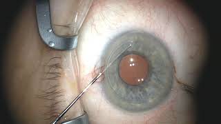 DMEK Descemets Membrane Endothelial Keratoplasty [upl. by Lenor]