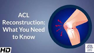 Anterior Cruciate Ligament reconstruction ACL Reconstruction What You Need to Know [upl. by Armanda]