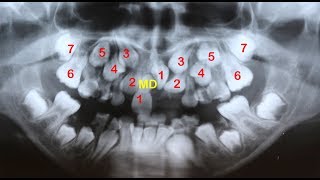 Amazing orthodontic treatment of multiple impactions [upl. by Hunger574]