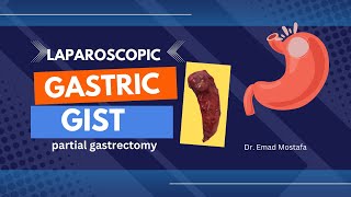 gastric GIST laparoscopic partial gastrectomy [upl. by Nevet]