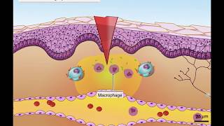 Réaction inflammatoire [upl. by Centeno]