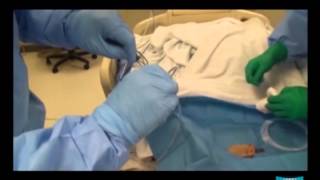 Percutaneous Endoscopic Gastrostomy pull method and Jejunal Extension Tube Placement [upl. by Eneri]