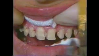 CARILLAS DE PORCELANA  ODONTOLOGIA COSMETICA  212 [upl. by Anoet241]