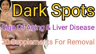 Subtitle Fix Dark Spots HyperpigmentationMelasma By Supplements Aging amp Liver Are Main Causes [upl. by Mia338]