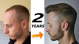 2 years after my FUE Hair Transplant in Istanbul Turkey [upl. by Aserehs643]