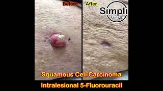 Squamous Cell Carcinoma Intralesional 5Fluorouracil [upl. by Fabio]