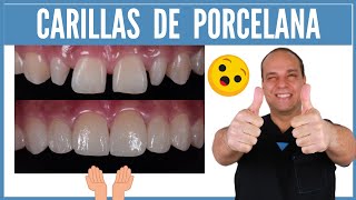 CARILLAS de PORCELANA 😮 ANTES y DESPUÉS ⭐ ¡No te Pierdas este CASO que te MUESTRO [upl. by Alage]