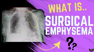 Surgical Emphysema Explained  Symptoms Causes Radiographic Features and Treatment [upl. by Enilamme194]